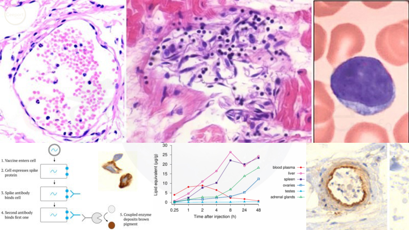 DANNO VASCOLARE E D’ORGANO INDOTTO DAI SIERI MRNA: PROVA INCONFUTABILE DI CAUSALITÀ DANNO VASCOLARE E D'ORGANO INDOTTO DAI VACCINI MRNA
